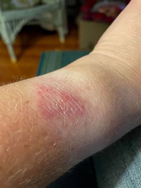 rash from wearing watch